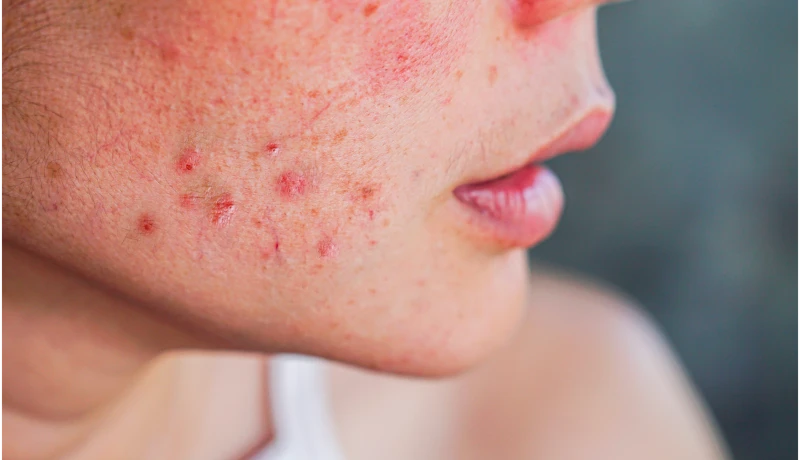 Tratamento de dermatite atópica pelo plano de saúde